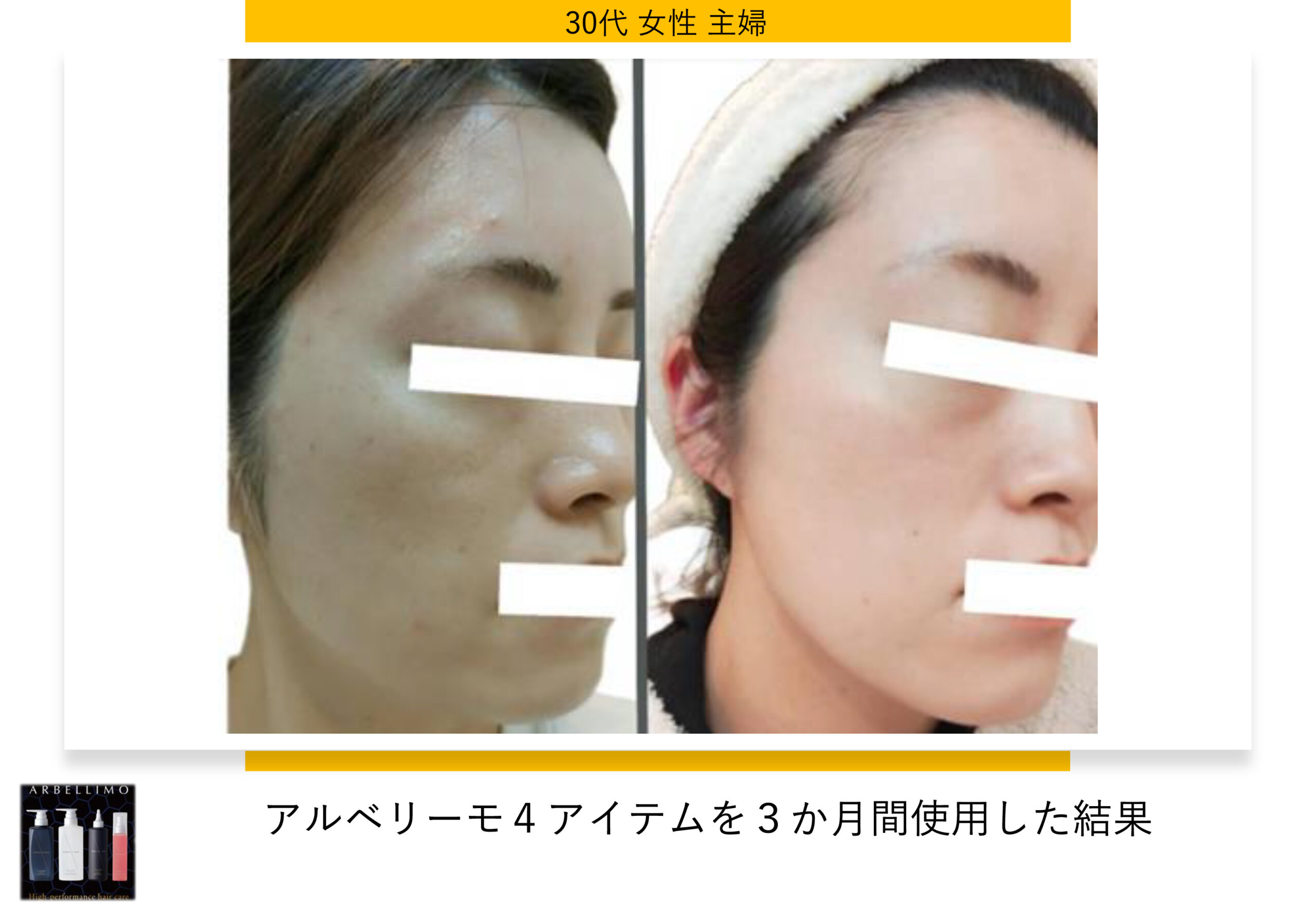 アルベリーモ,上がるシャンプー,エイジングケア,リフトアップ,スキャルプケア,育毛,養毛,LPS